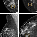Google AI Beats Doctors at Breast Cancer Detection—Sometimes