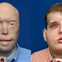 (Video) World’s Most Complex Face Transplant Operation Made Possible with 3D Printing