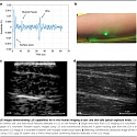 (Paper) Full Noncontact Laser Ultrasound : First Human Data