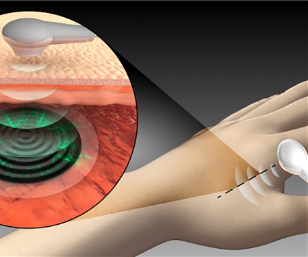 (Paper) Biocompatible Battery for Medical Implants is Charged via Ultrasound