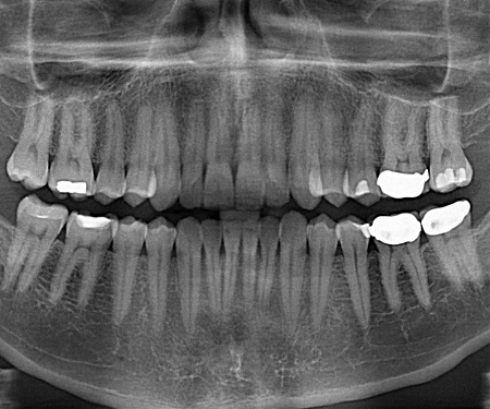 The End of Root Canals ?
