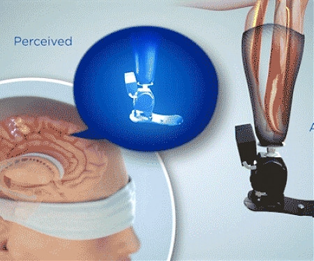 MIT - Surgical Technique Improves Sensation, Control of Prosthetic Limb