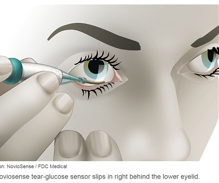 Why Noviosense's In-Eye Glucose Monitor Might Work Better Than Alphabet's