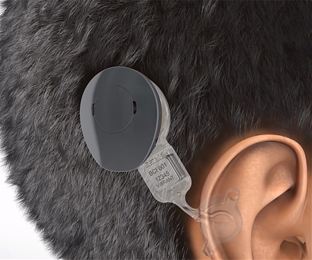 (Video) World's First Wireless Bone Conducting Hearing Aid - BONEBRIDGE