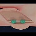 MIT - Ushering In A New Era Of Suture-Free Tissue Reconstruction For Better Healing