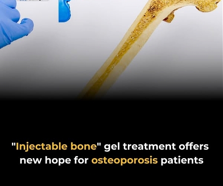 EPFL - An Injectable Hydrogel for Local Bone Densification