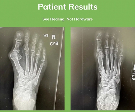 A Medical Device Company, Ossio Raised $27.6M