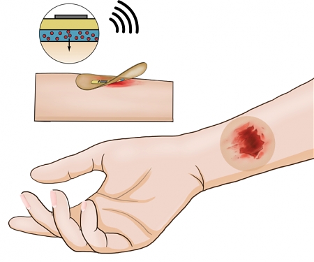 Stanford - Wireless Smart Bandage Provides New Insights On Healing Chronic Wounds