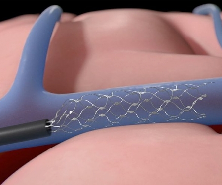 MedTech Synchron Raises $40M to Trial Neurotech That Helps Paralysis Patients Email