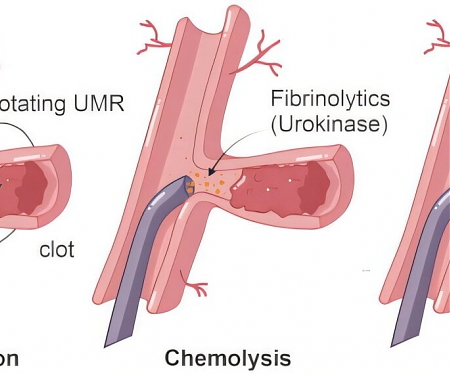 (Paper) Magnetic Microrobots Remove Blood Clots From Sheep Iliac Artery