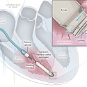 New Wireless Pacemaker Implanted Without Surgery, Found Safe in Clinical Study