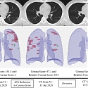 Hospitals Deploy AI Tools to Detect COVID-19 on Chest Scans