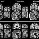 Artificial Intelligence Helps Improve MRI Imaging of Strokes