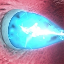 (Video) UV-Light Enabled Catheter Fixes Heart Defects Without Surgery