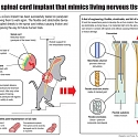 Spinal Implant Could One Day Let Paralyzed People Walk Again