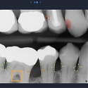 Overjet Raised $42.5M for Its Dental AI Tech