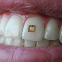 Tooth Sensors Could Be Used to Monitor Your Diet
