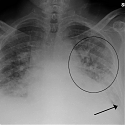 (Paper) MIT - Anticipating Heart Failure with Machine Learning