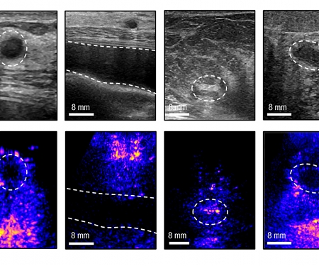 (Paper) MIT - A Portable Ultrasound System Could Make Reliable Breast Imaging More Accessible